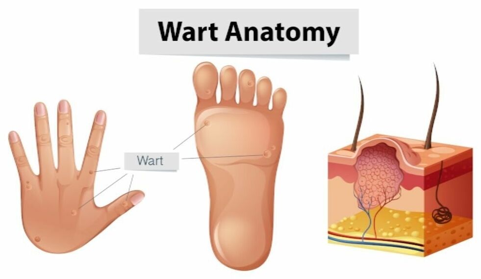 Successfully remove warts from the root with Removio