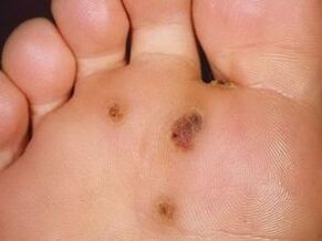 How to get rid of Plantar warts