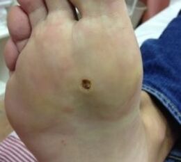 The ways to remove warts on the base of the leg