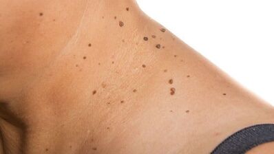 How to remove papilloma around the neck