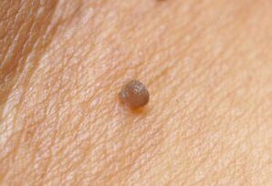 Clinical image of papilloma