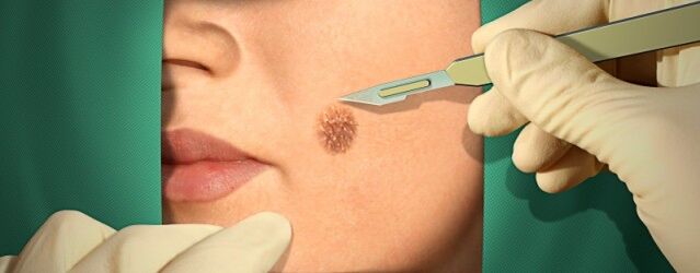 Treatment of papilloma surgery