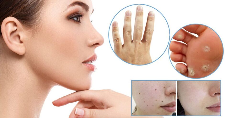 Papillomas removal method