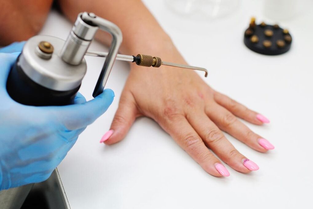Remove papilloma with liquid nitrogen