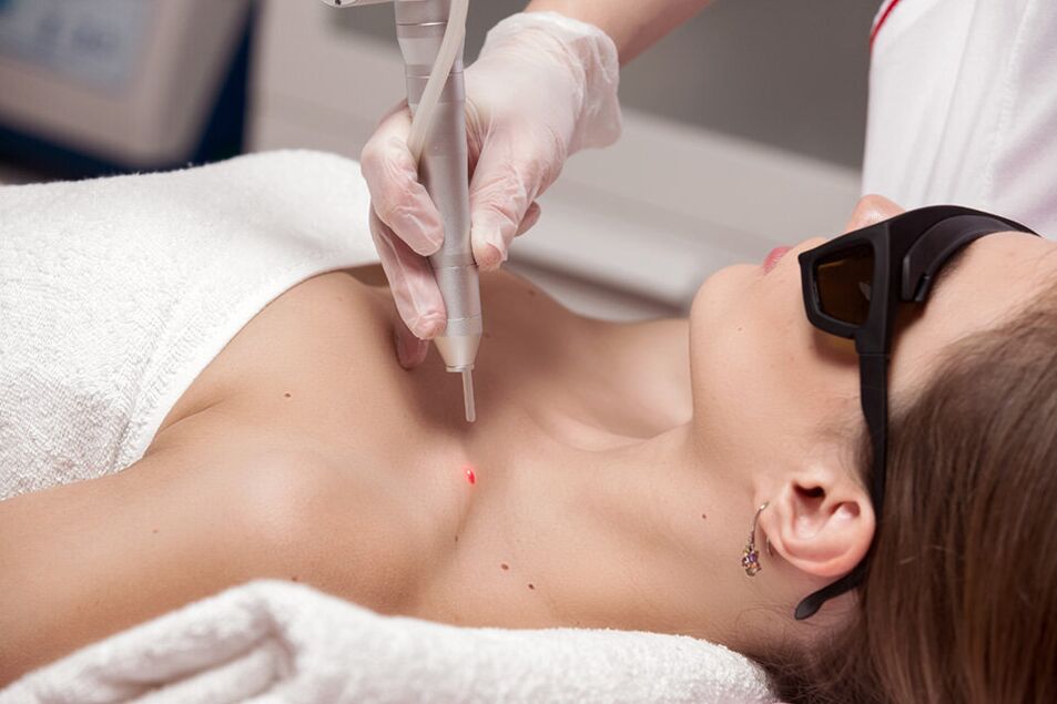 Remove the laser of papillary