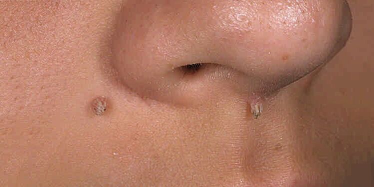 Reasons for the appearance of papillary