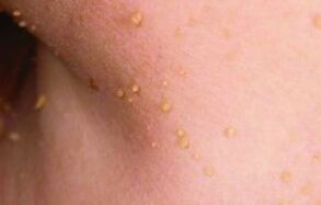 Reasons for the appearance of papillae on the body