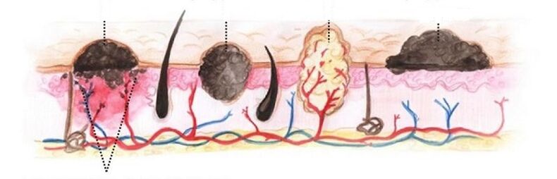 Types of papillomas on the human body