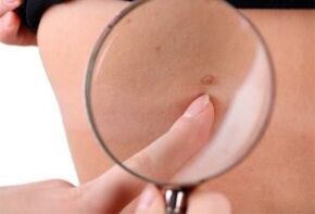 main cause of papillomas
