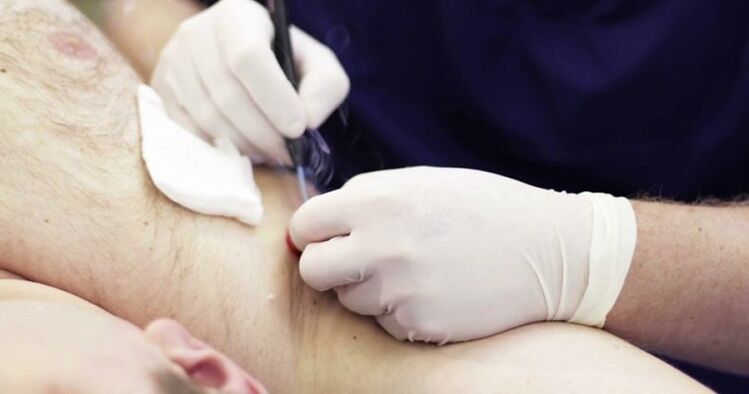 Professional method for removing papillomas on the human body