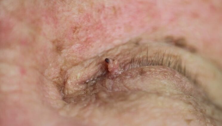 papilloma on eyelid how to get rid of it