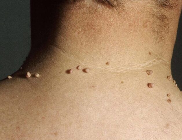 Papilloma on a man's neck