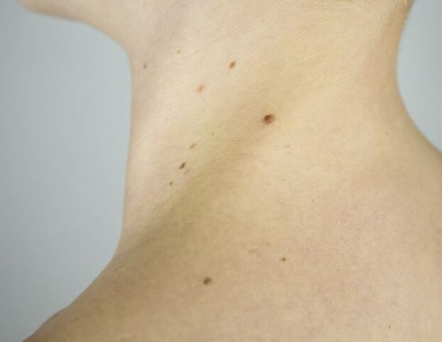 Papilloma on the girl's neck