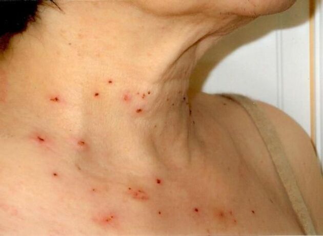 Results of cervical papilloma treatment
