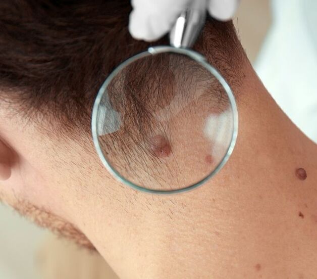 The doctor examined the papilloma in the neck