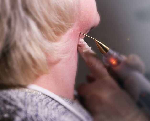 The process of removing papillomas from the neck of women