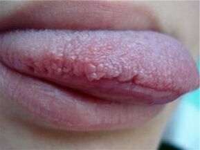 Papilloma on tongue