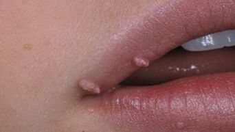 Papillomas on lips
