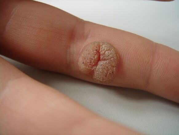 Complications of self-removal of papillomas