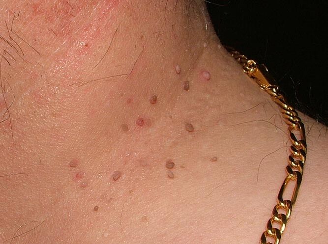 Papilloma on the neck