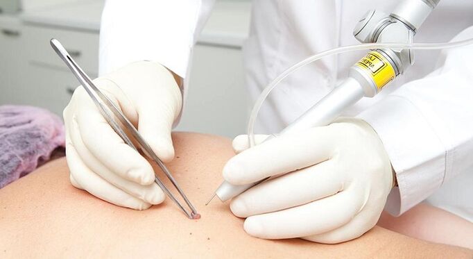 Laser papilloma removal for papillomavirus