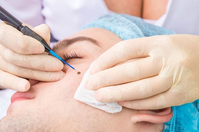 removal of facial papillomas caused by human papillomavirus