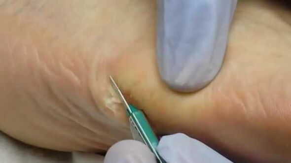 Wart removal surgery