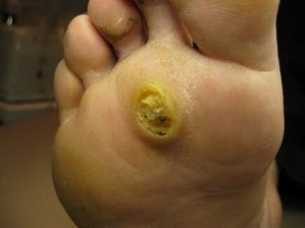 Warts on the soles of the feet