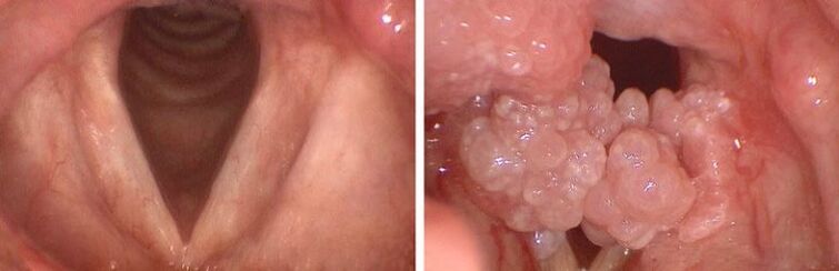 clear throat and papillae in pharynx