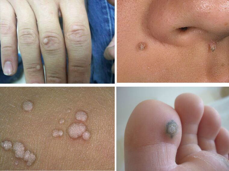 common warts